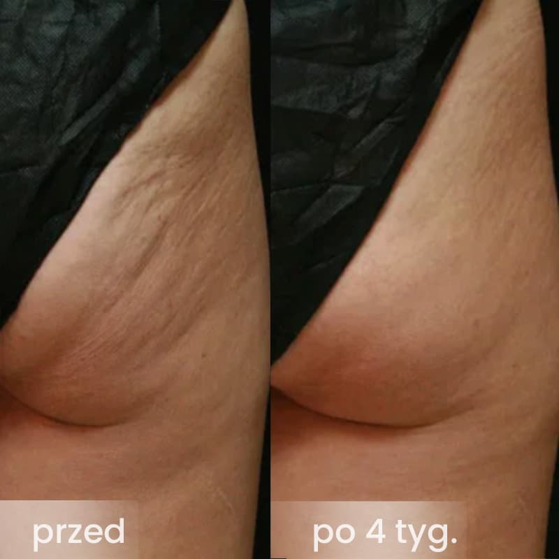 SlimRoll - modelująco-masujący roller